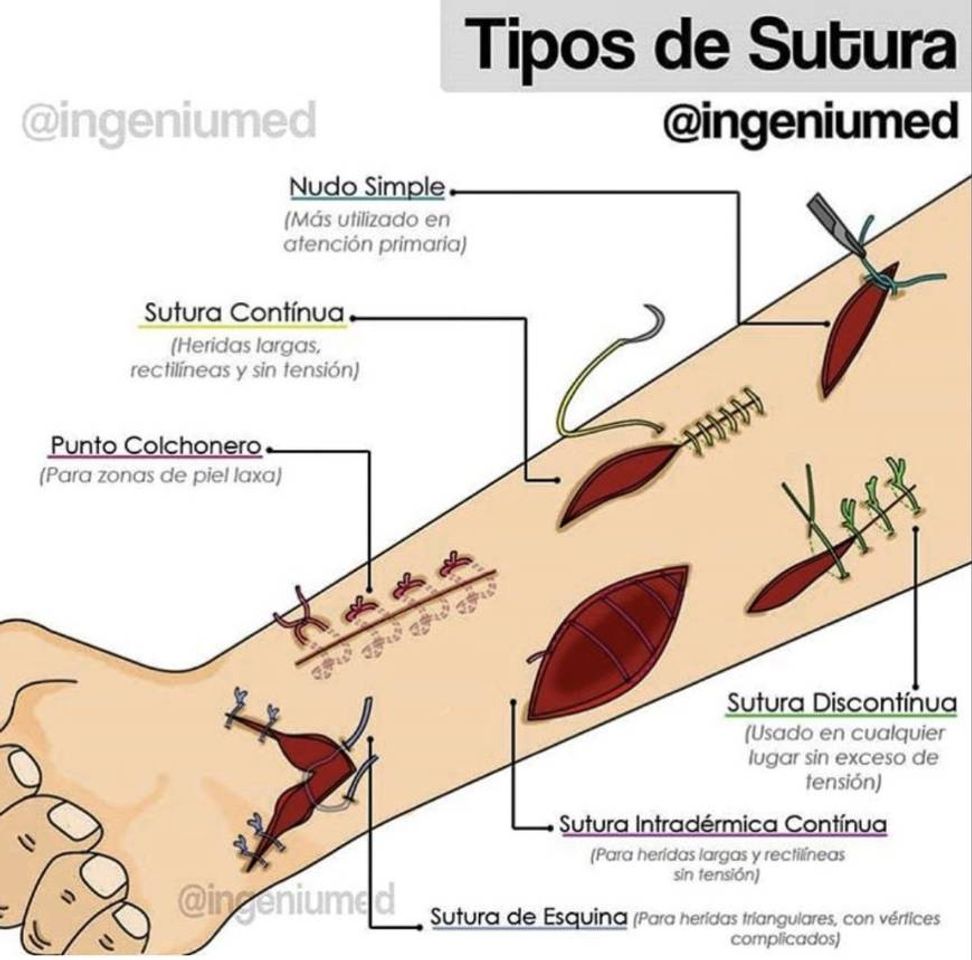 Moda suturas