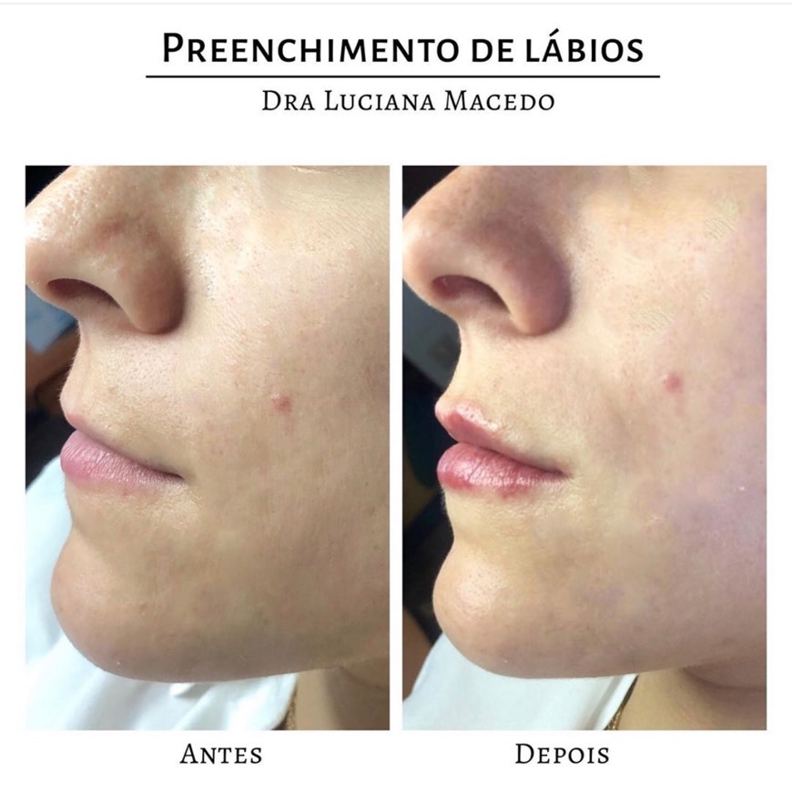 Products Preenchimento de lábios com Juvederm Ultra Smile 