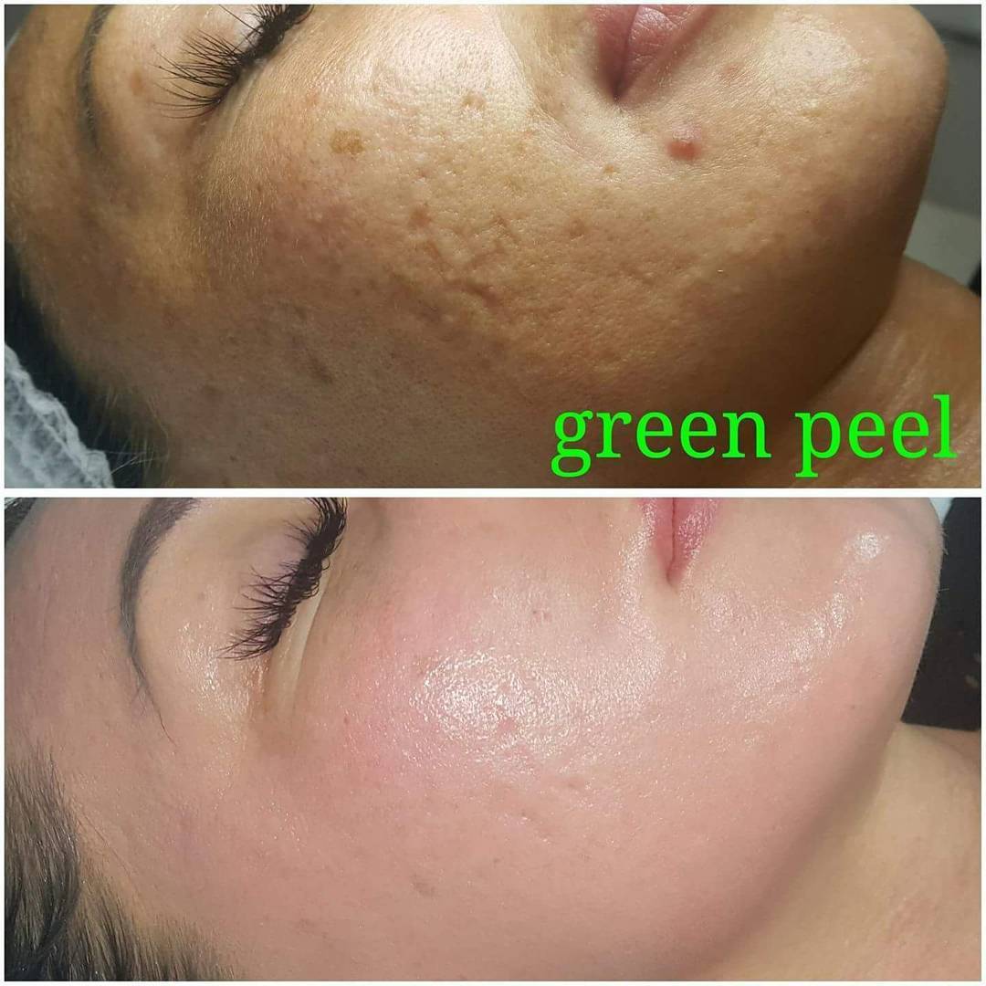 Product Green Peel