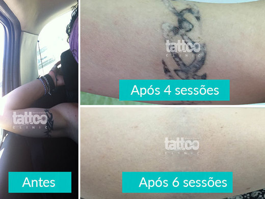 Tattoo Clinic - Remoção de Tatuagem - Faro
