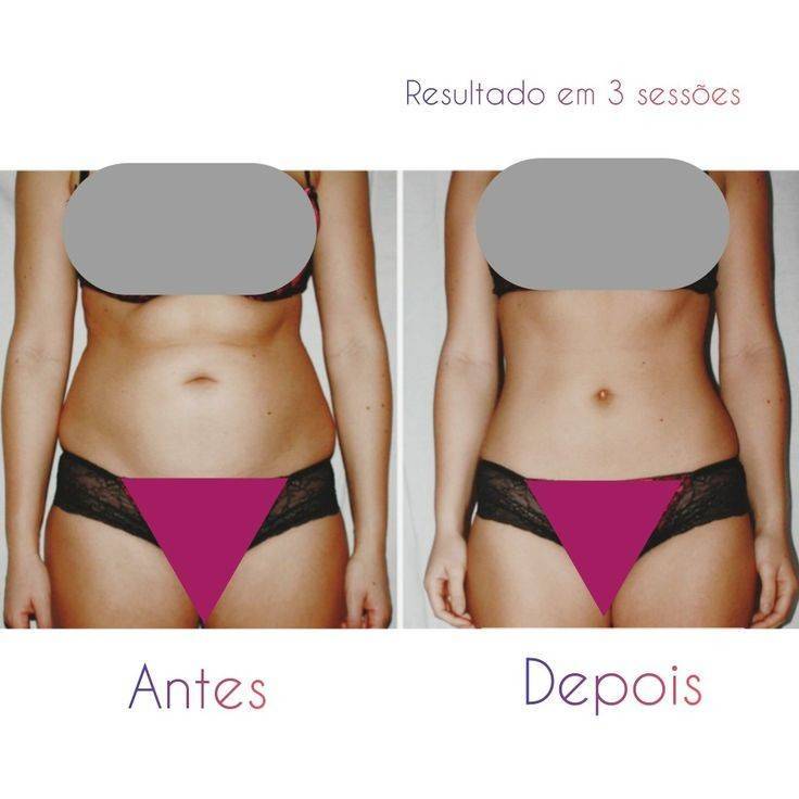 Fashion Resultados do Método DrenoPowerPlus 3 sessões