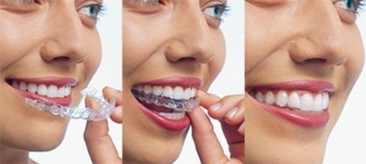 Invisalign