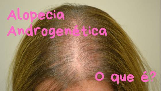 Fashion Alopecia Androgenética: o que é?