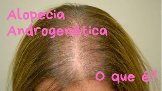 Alopecia Androgenética: o que é?