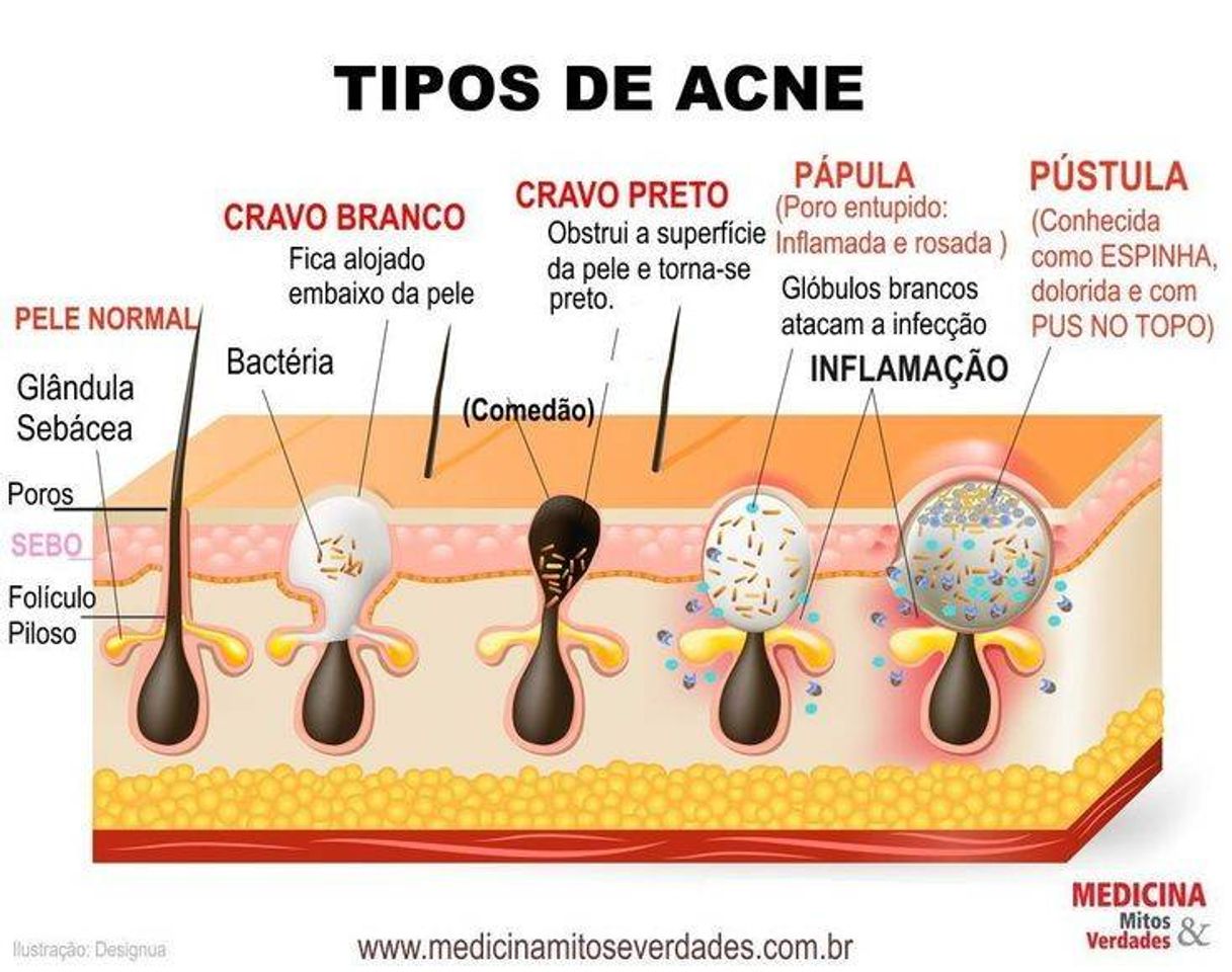 Fashion Acne tipos