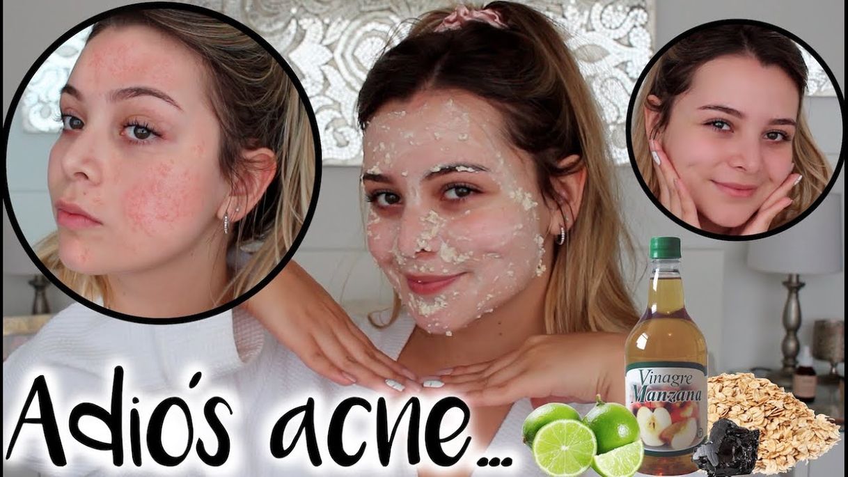 Moda Rutina para eliminar el acné y sus cicatrices! Remedios Naturales ...