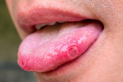 Cómo curar llagas en la boca y aftas en la lengua