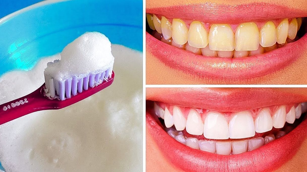 Moda Como Blanquear Los Dientes De Forma Natural