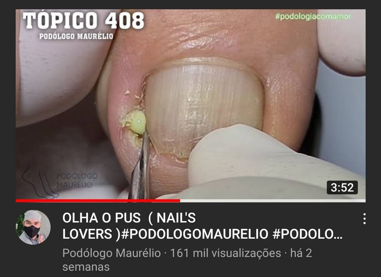 Unha encravada!
