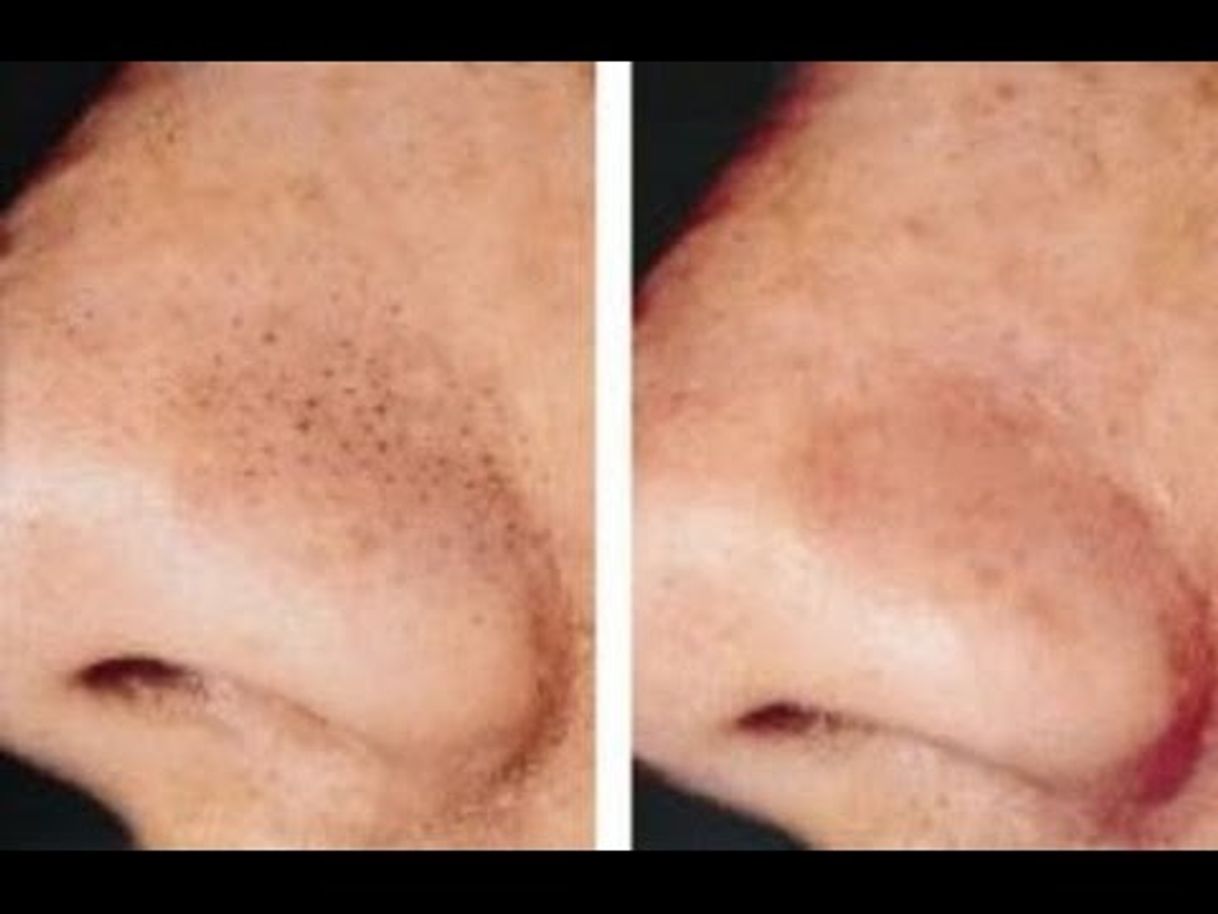 Cómo Eliminar Puntos Negros De La Nariz 