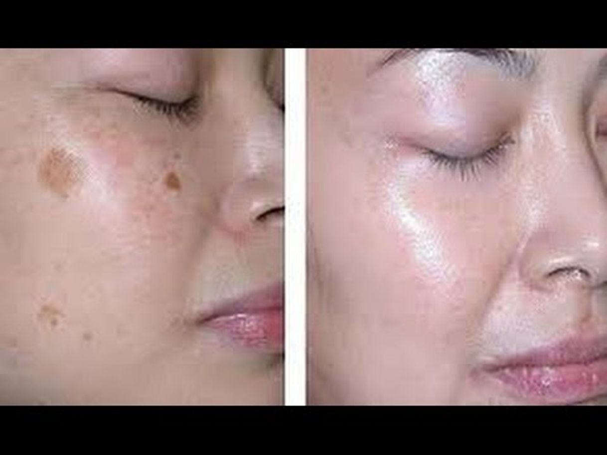 Social Quita las manchas de tu piel