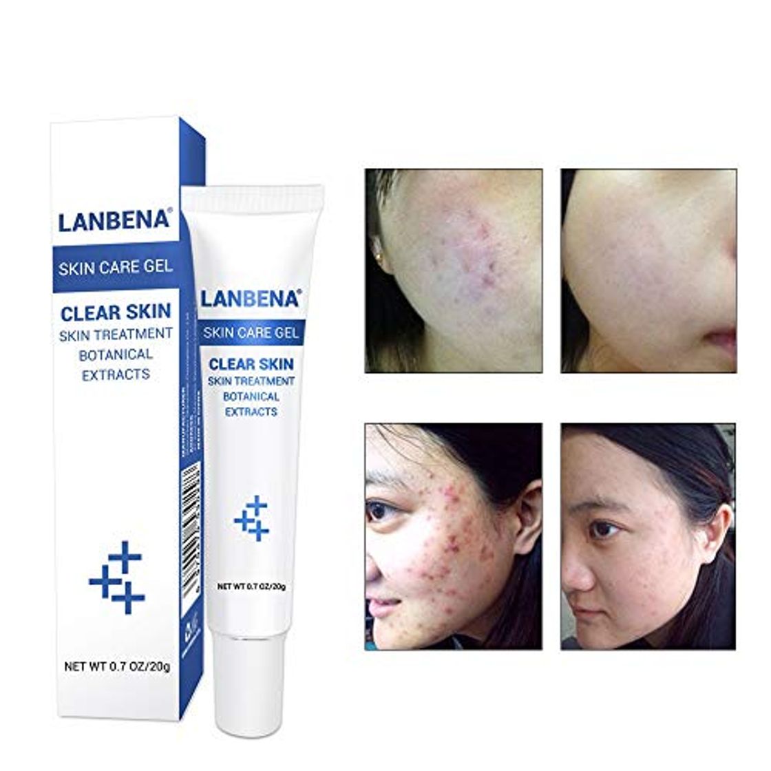 Place Acne Tratamiento Gel Limpieza Acné Crema Blackhead Remover Acne Spots Cara Acne