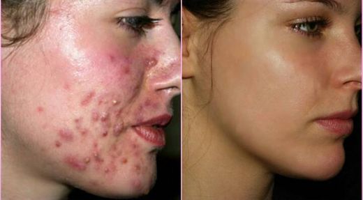 Como eliminar el acné 