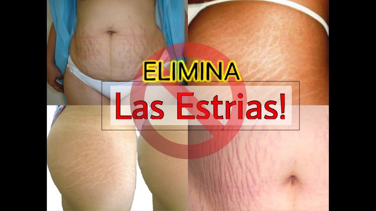 Fashion COMO ELIMINAR LAS ESTRIAS EN 1 MES! 5 Formas Caseras y ...