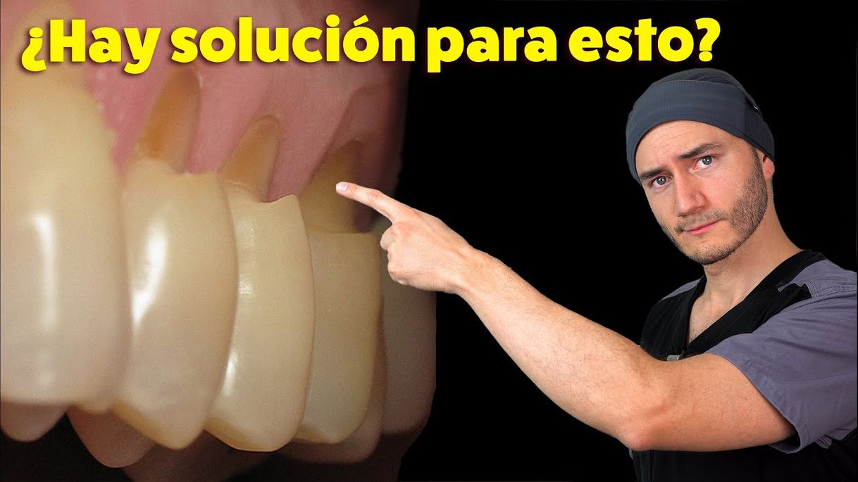 Fashion Desgastes en el cuello de los dientes | Causa y Solución 