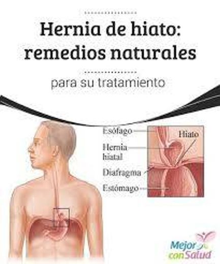 Hernia de hiato. 10 Remedios y ejercicios para su tratamiento ...