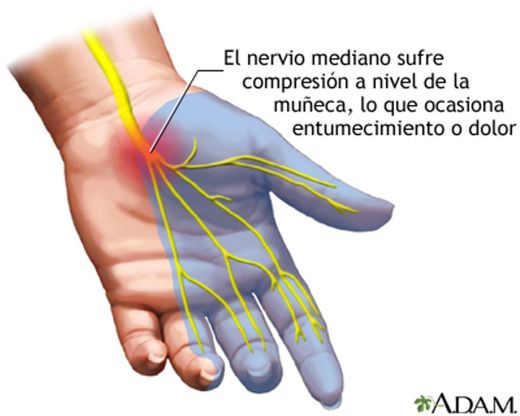 SÍNDROME DEL TUNEL CARPIANO 