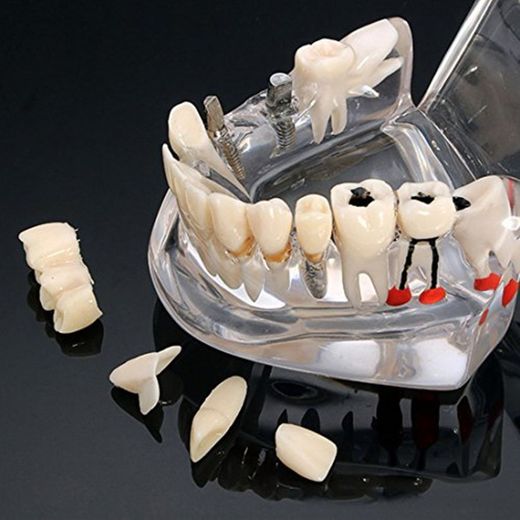 Modelo de dientes de enfermedad de implante dental con puente de restauración Modelo de ortodoncia de maloclusión para ciencia médica dental