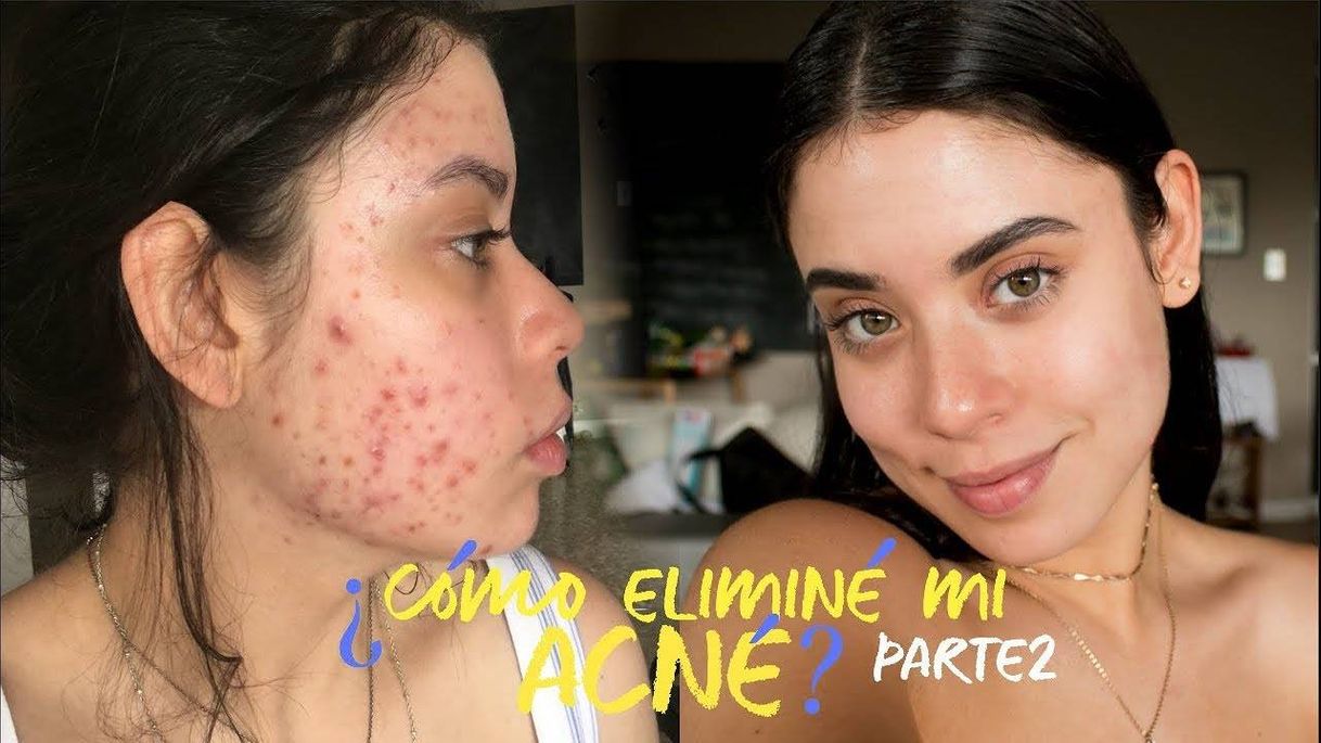 Social ¿CÓMO ELIMINAR EL ACNÉ NATURALMENTE ? +¿CÓMO LIMPIÉ MI PIEL?