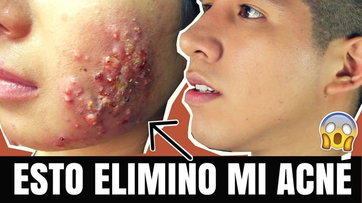 Social ¡YA NO TENGO ACNÉ POR USAR ESTO! 😮| 