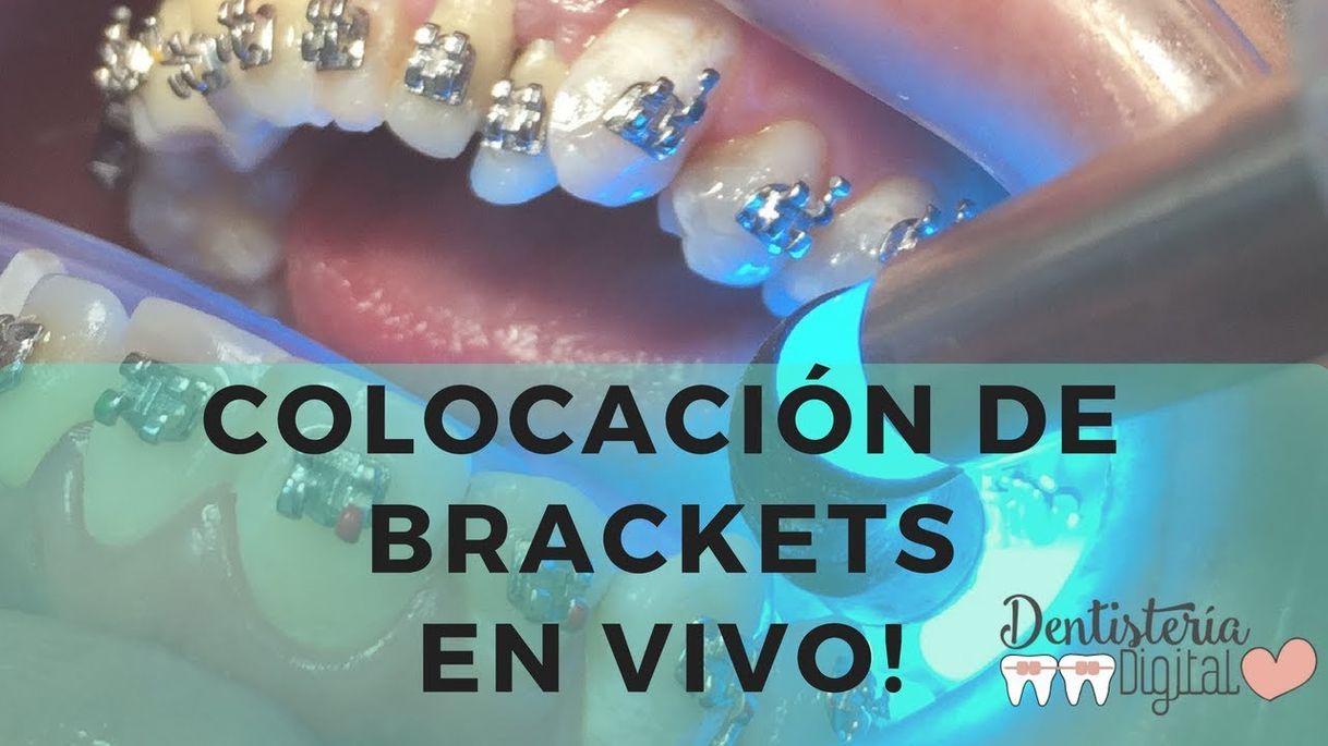 Fashion Colocación de Brackets en VIVO / Dentisteria Digital 