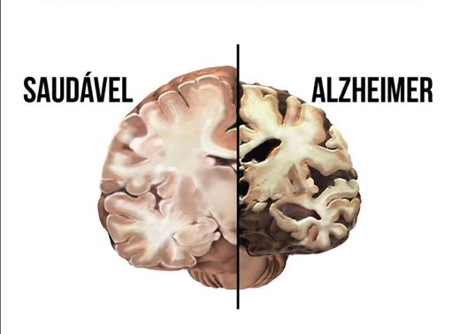 Alzheimer: o que é, causas, sintomas, tratamento, diagnóstico e ...