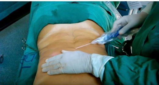 Mini Abdominoplastia: Cirurgia de Abdômen - Dra. Luciana Pepino