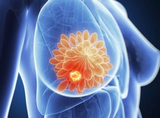Câncer de mama: sintomas, tratamentos, causas e prevenção