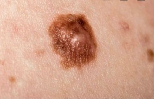 tipos de câncer de pele, o melanoma