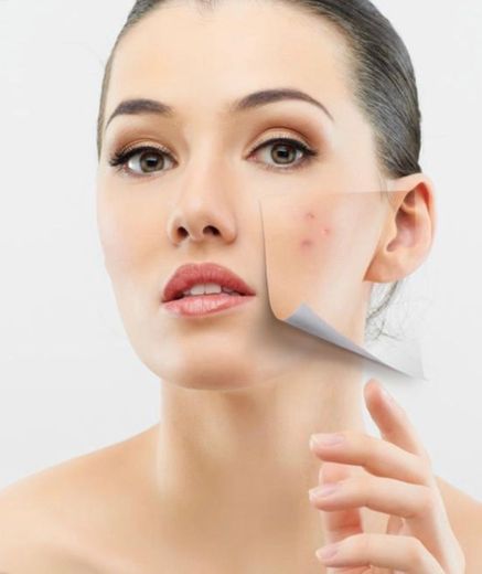 Esto te ayudará a deshacerte de las marcas del acné en 4 días