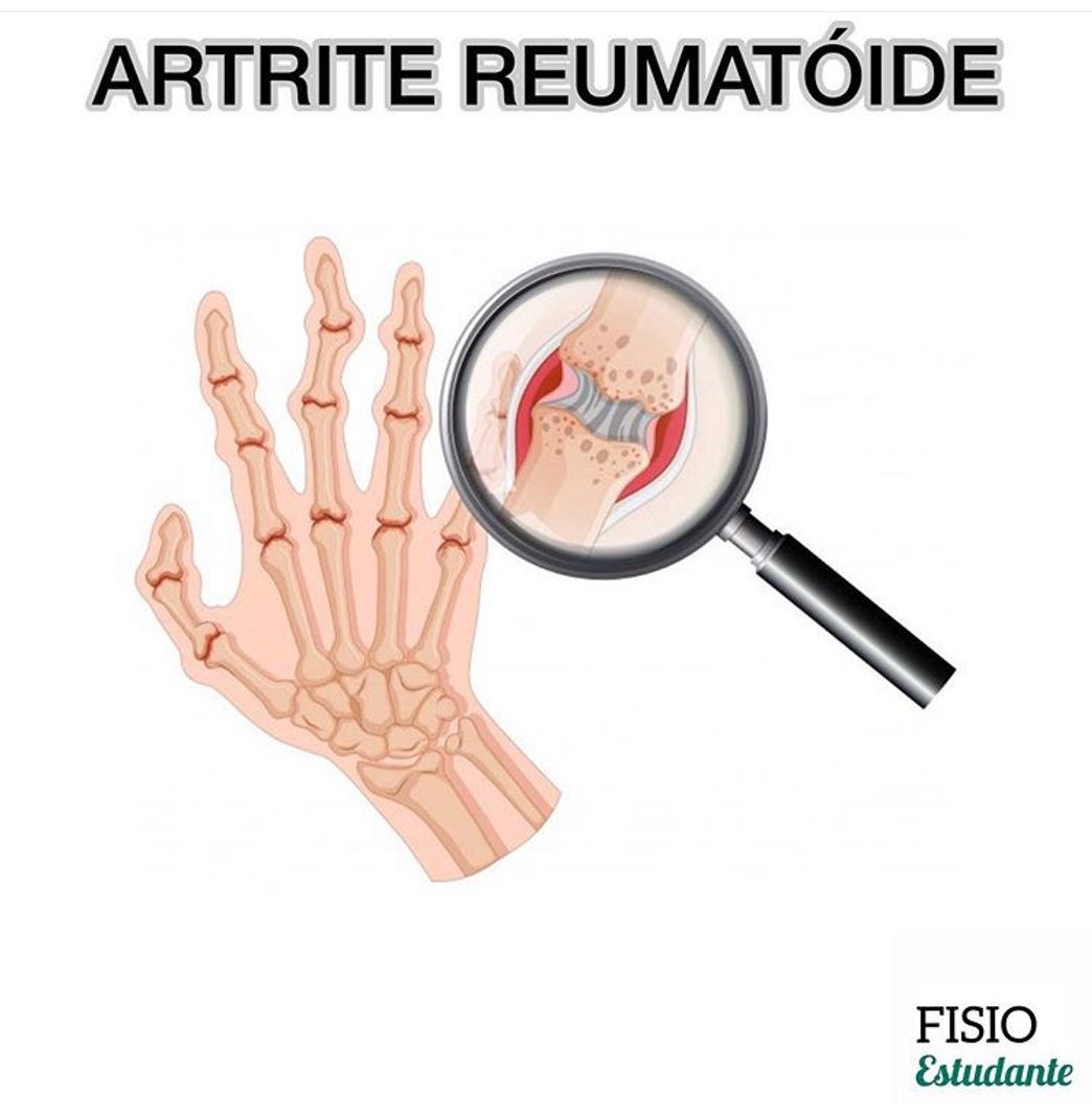 Fashion Artrite reumatoide