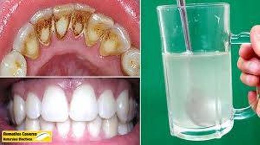 ¿Remover Sarro Dental en 5 minutos con Remedios Caseros ...