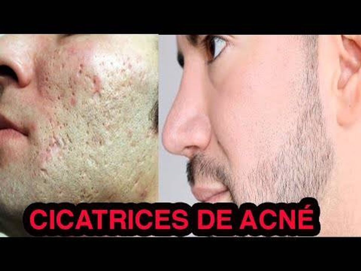 Fashion COMO ELIMINAR CICATRICES DE ACNÉ EN CASA - YouTube