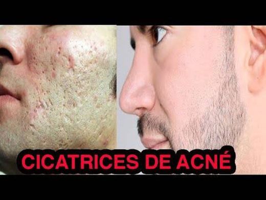 COMO ELIMINAR CICATRICES DE ACNÉ EN CASA - YouTube