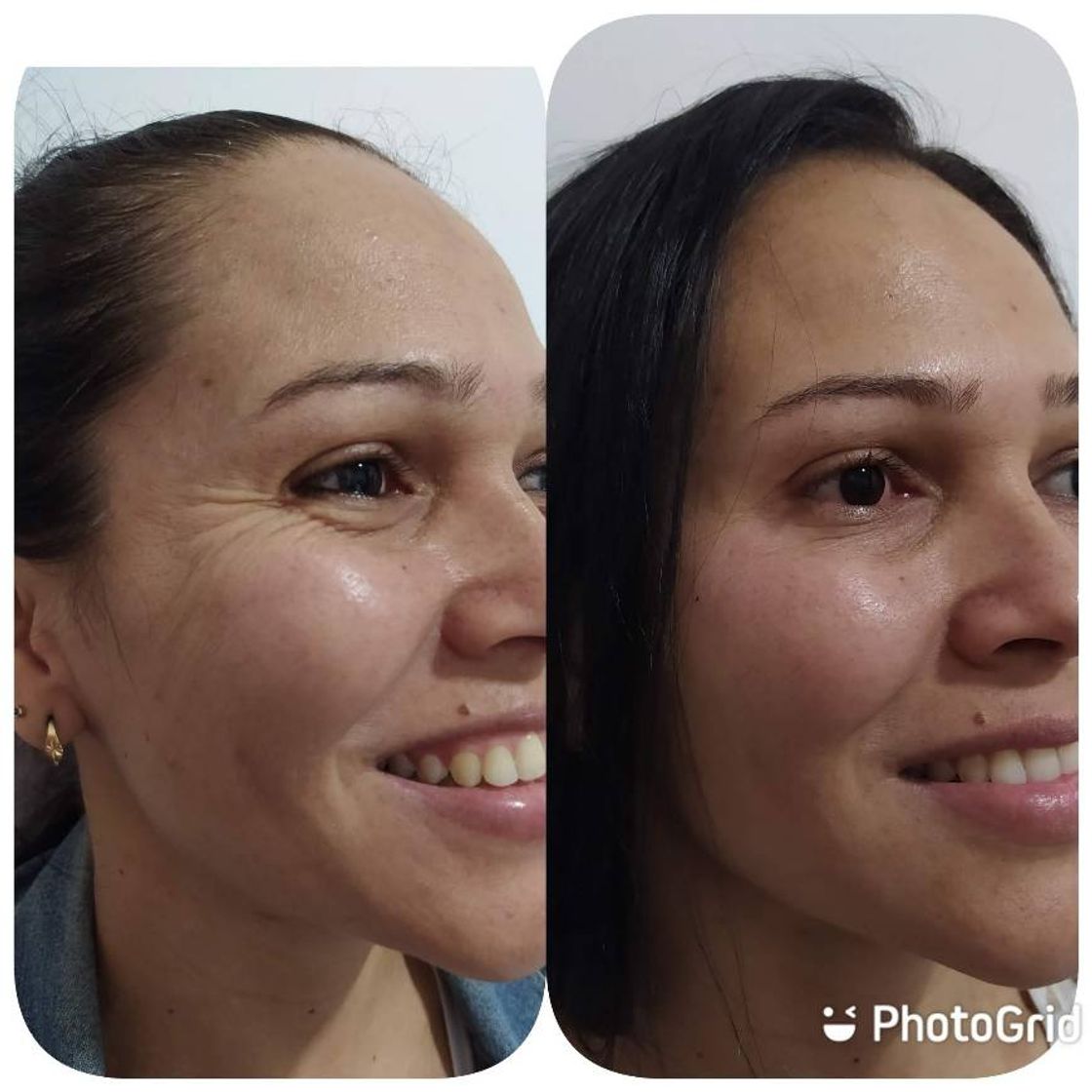 Fashion Botox preventivo para linhas de expressão. 4x de R$175