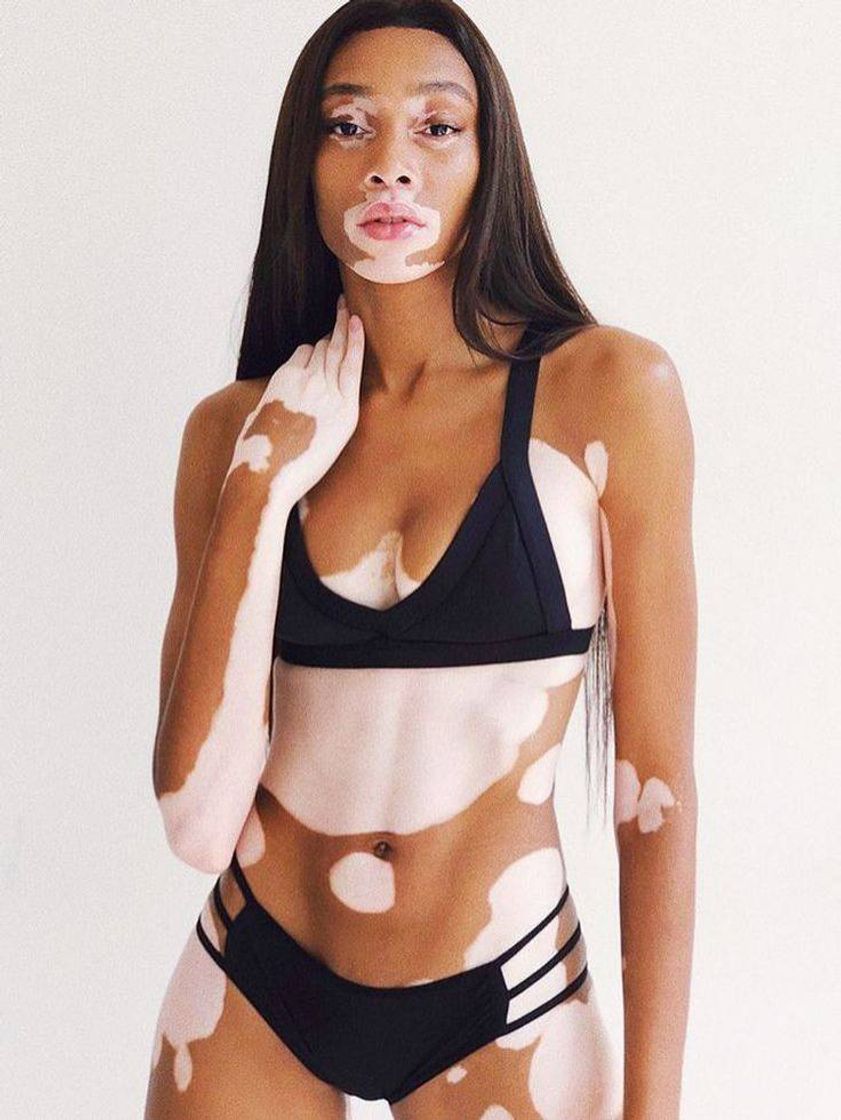 Moda Vitiligo