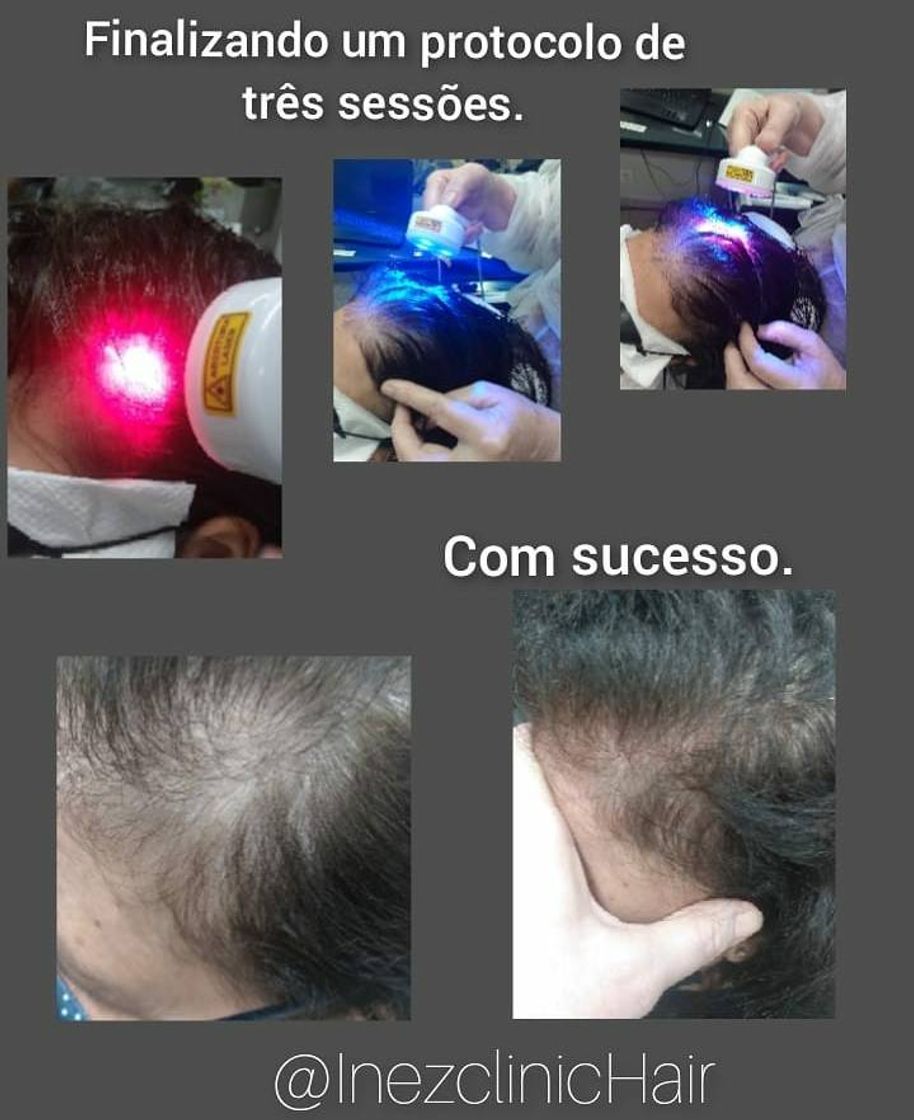 Fashion Tratamento para queda de cabelo.