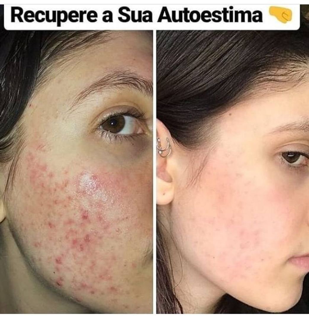 Moda Cleancaps solução pra acne, cravos e manchas na pele