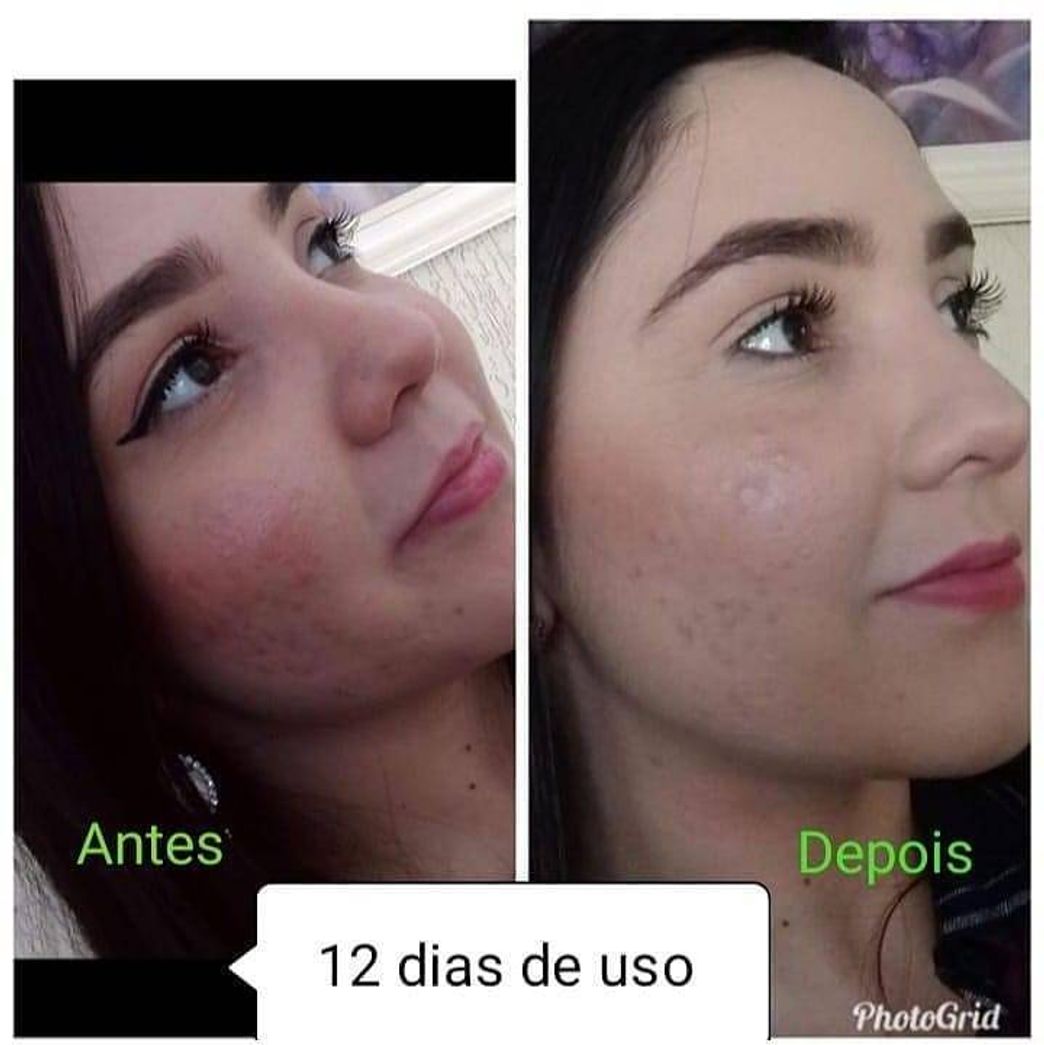 Moda Cleancaps solução definitiva contra Acne e mancha na pele