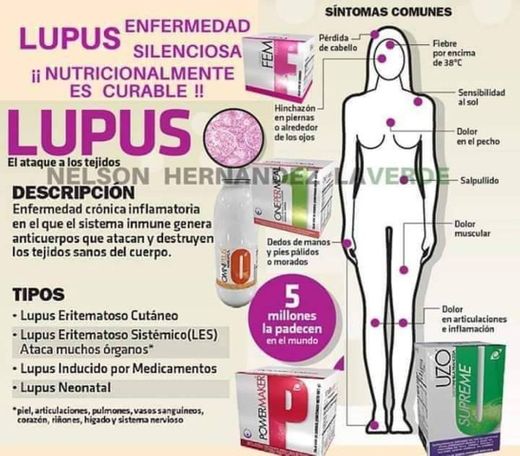 Tratamiento natural para el LUPUS