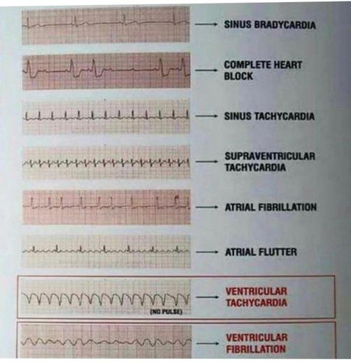 ECG 