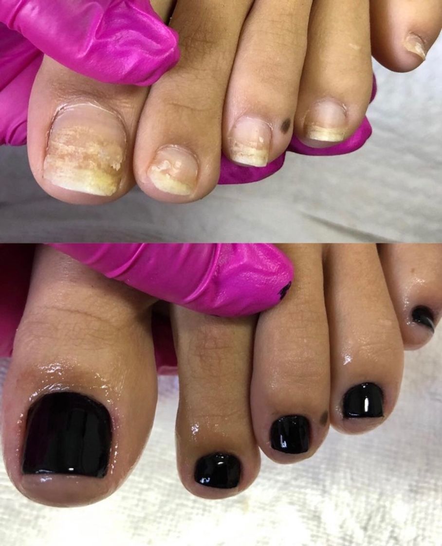 Moda Unhas dos pés antes e depois 