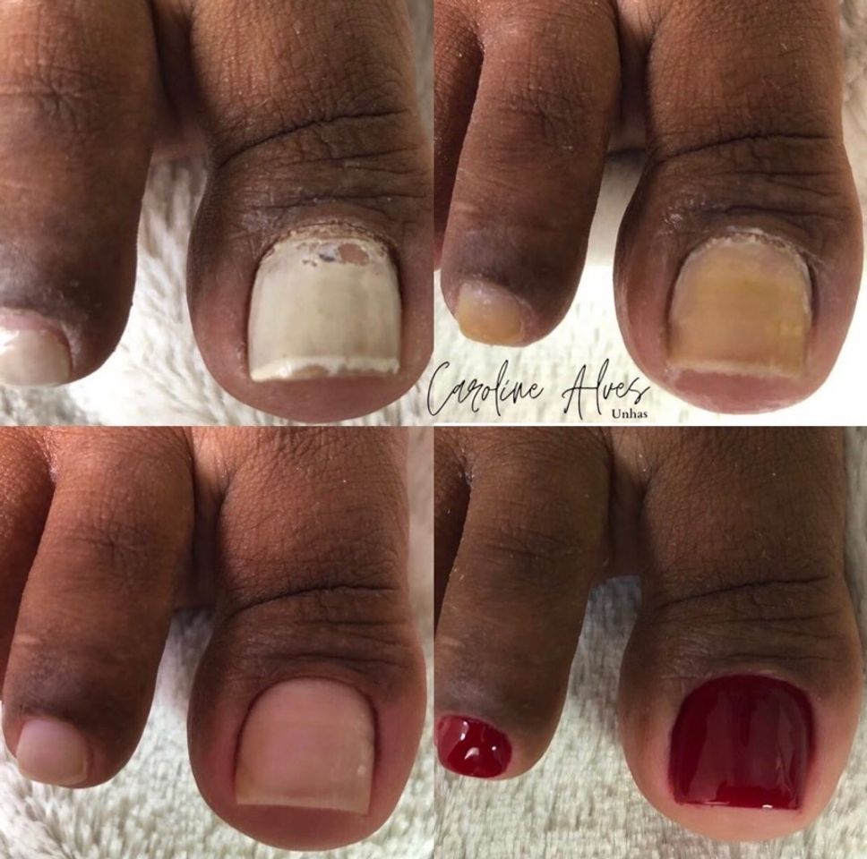 Moda Pés antes e depois unhas 👣👣