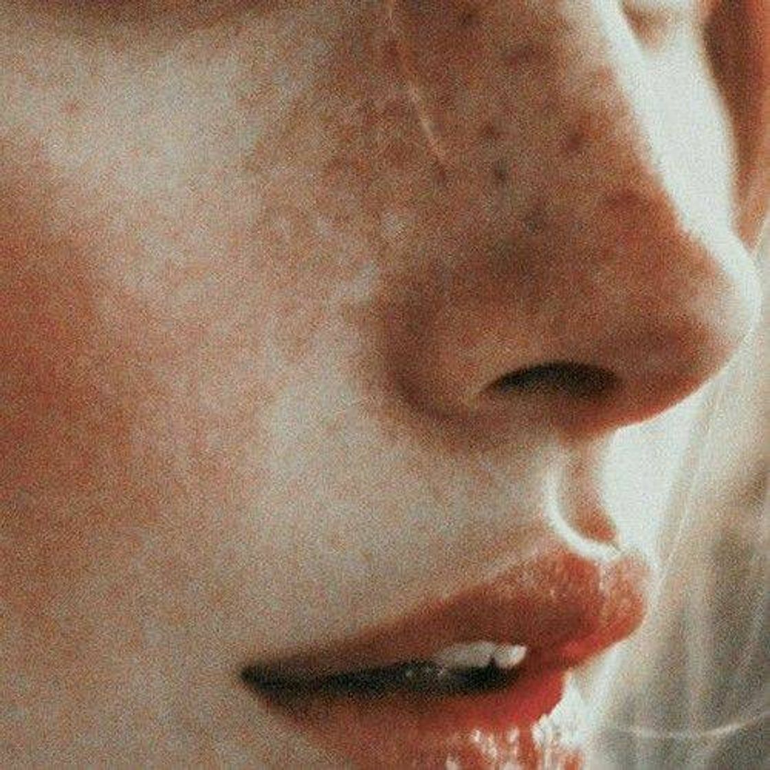 freckles