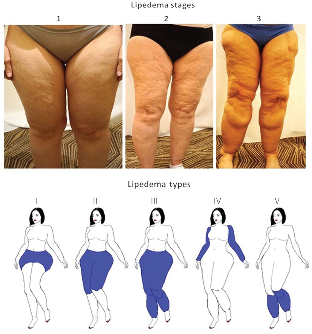 Moda Lipedema