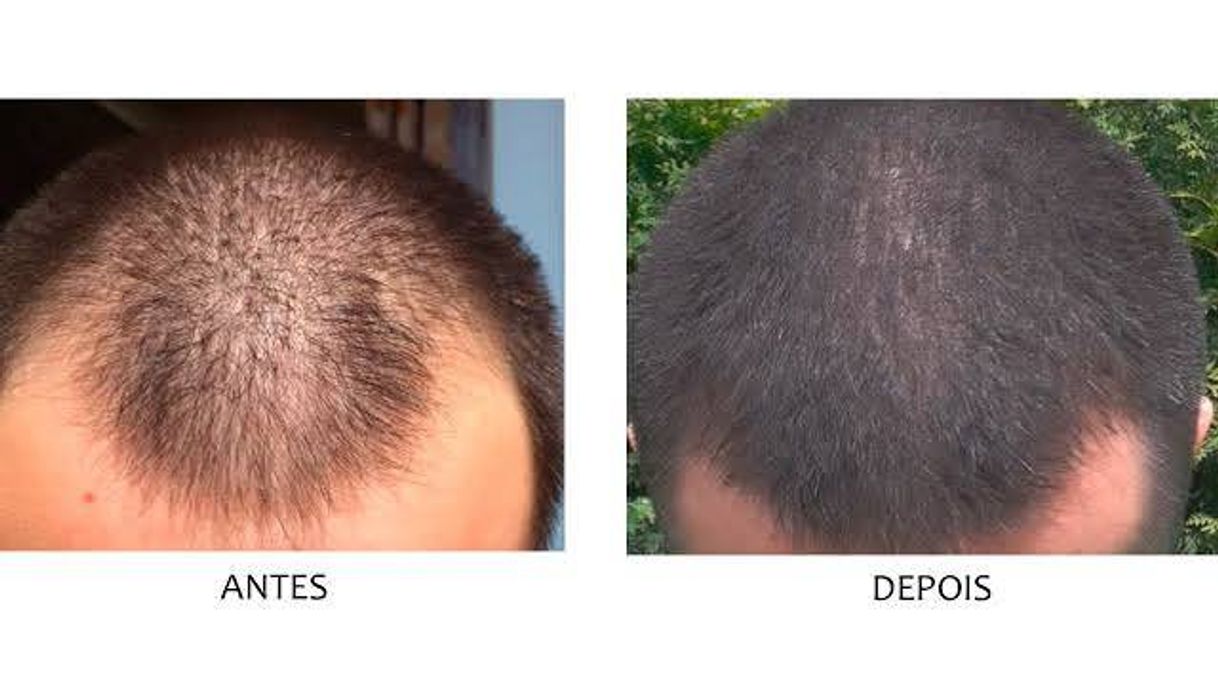 Fashion Trioxidil, um complexo nutritivo de tripla ação desenvolvido