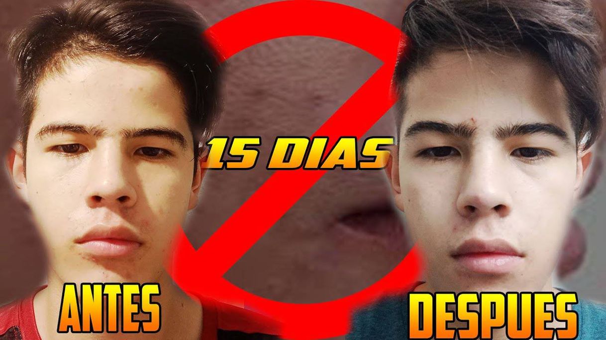 Moda Así ELIMINE el 80% de mi ACNE en 15 DIAS 