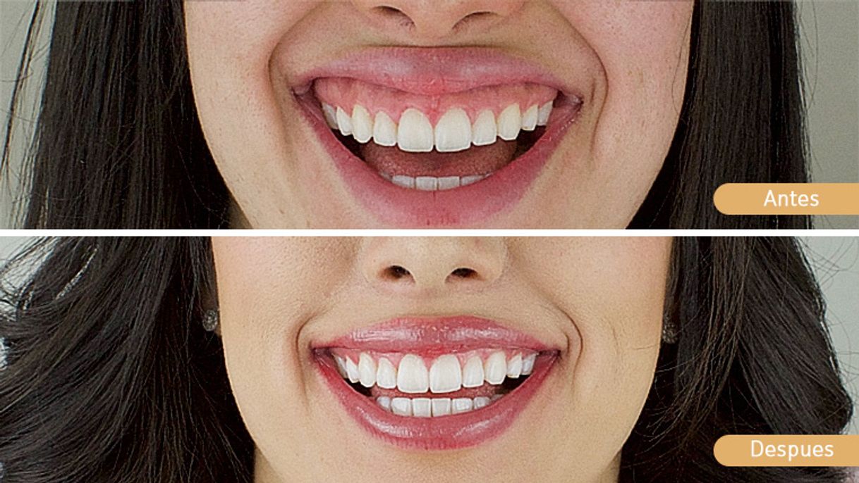 Fashion Tratamiento de la sonrisa gingival con Botox 