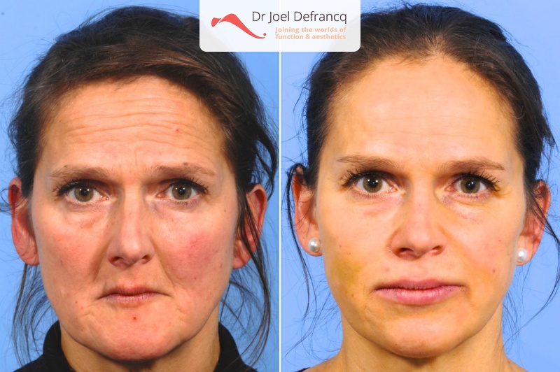 Fashion Lipofilling facial 