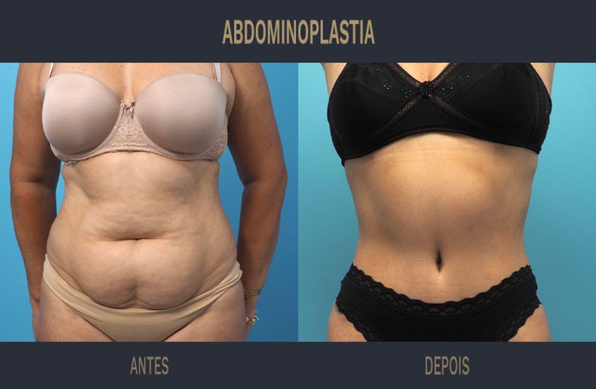 Moda Abdominoplastia 